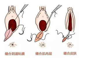 顺产撕裂伤多久恢复