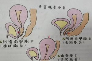 产后盆底功能障碍有哪些危害？